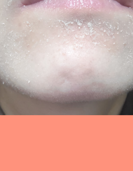 トレチノイン治療によるあごの皮むけの写真2