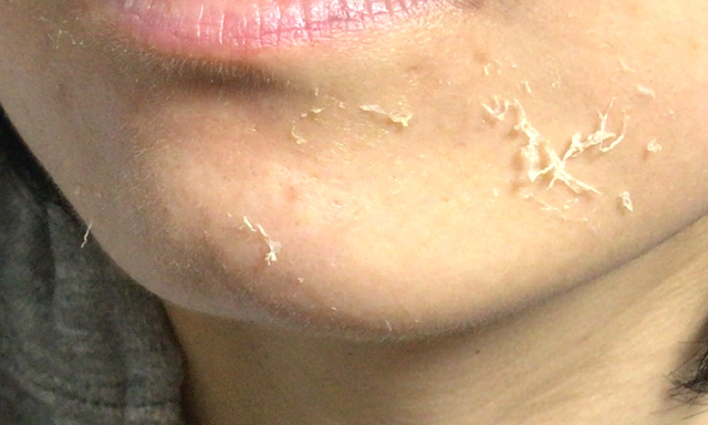 トレチノイン治療によるあごの皮むけの写真3