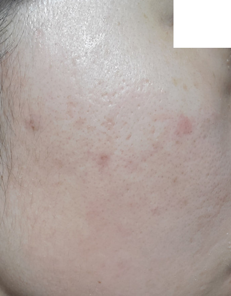 トレチノイン治療14日目の左頬の写真