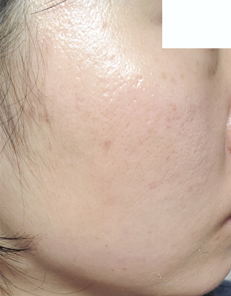 トレチノイン治療21日目の左頬の写真