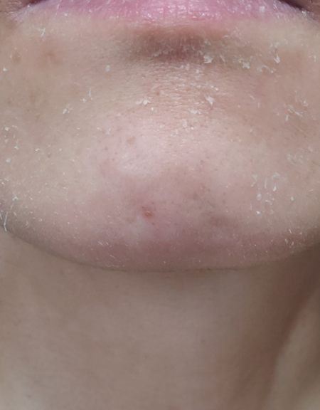トレチノイン治療によるあごの皮むけの写真1